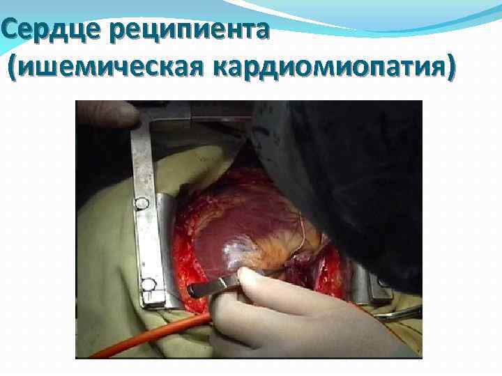 Сердце реципиента (ишемическая кардиомиопатия) 