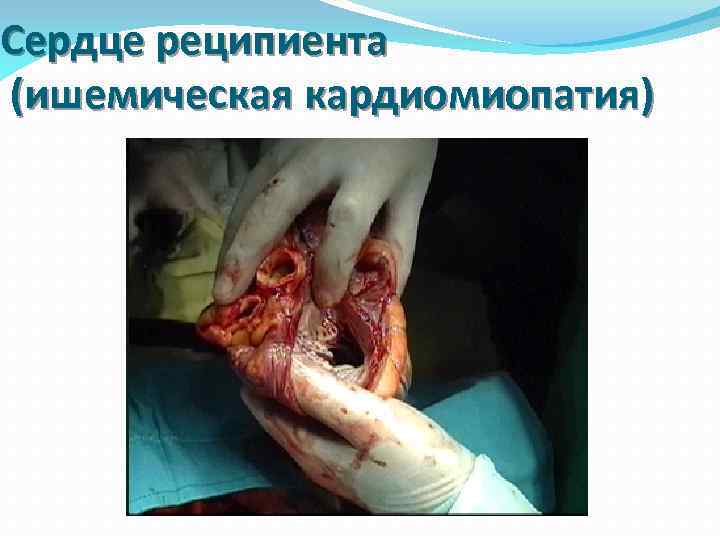 Сердце реципиента (ишемическая кардиомиопатия) 