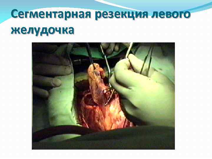 Сегментарная резекция левого желудочка 