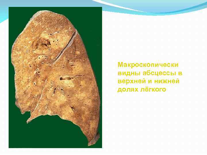 Макроскопически видны абсцессы в верхней и нижней долях лёгкого 