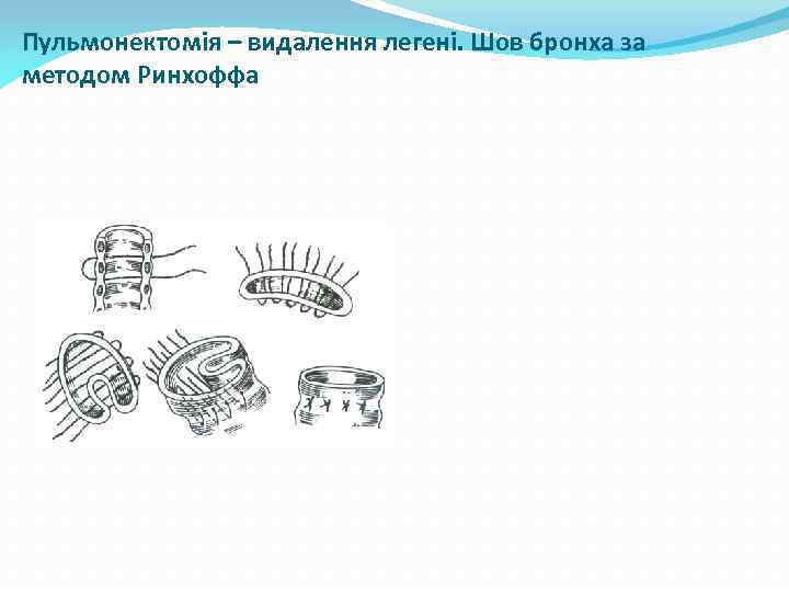 Пульмонектомія – видалення легені. Шов бронха за методом Ринхоффа 