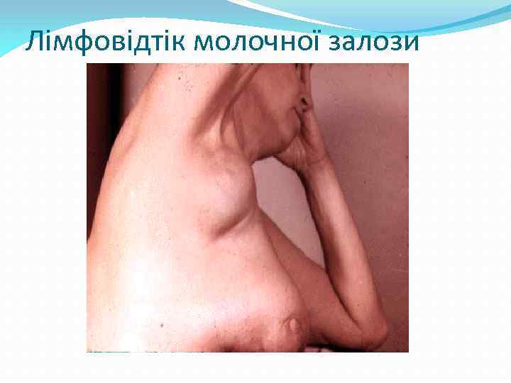 Лімфовідтік молочної залози 