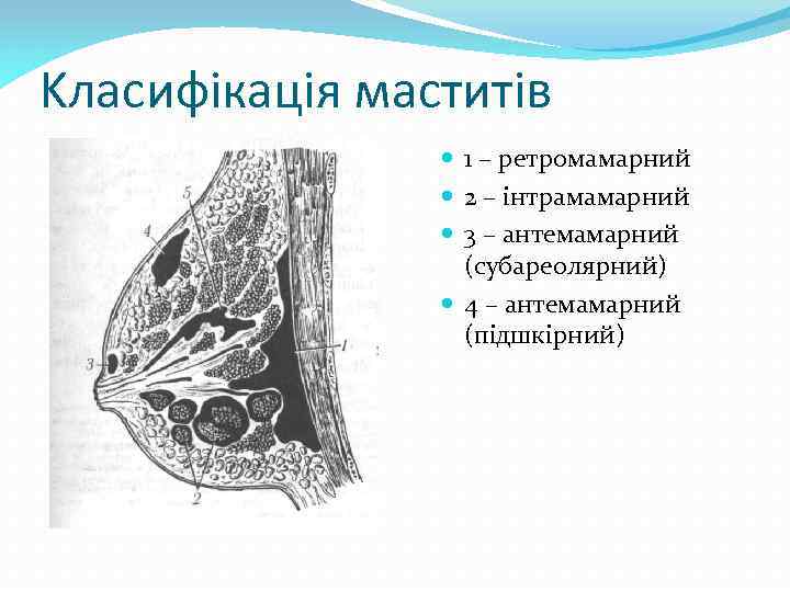Kласифікація маститів 1 – ретромамарний 2 – інтрамамарний 3 – антемамарний (субареолярний) 4 –