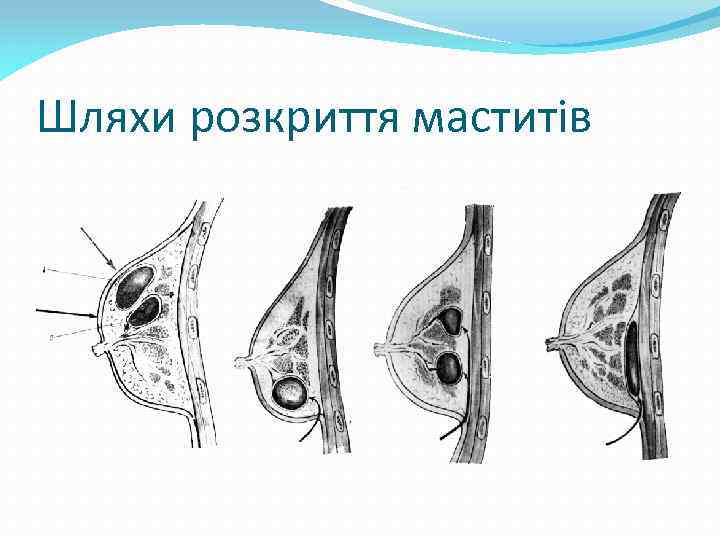 Шляхи розкриття маститів 