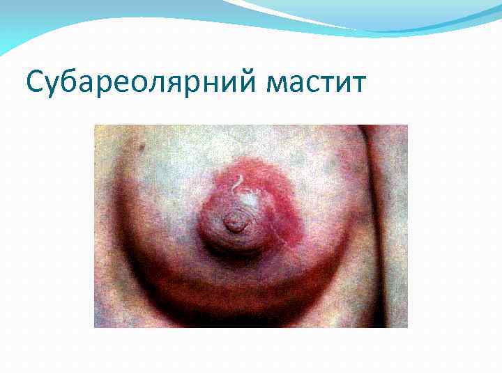 Субареолярний мастит 