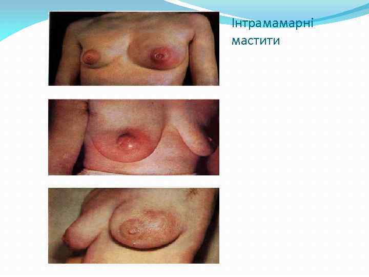 Інтрамамарні мастити 
