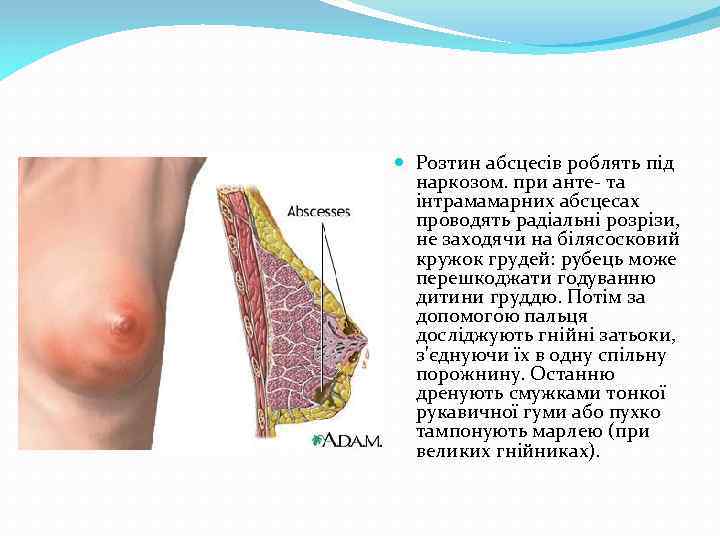  Розтин абсцесів роблять під наркозом. при анте та інтрамамарних абсцесах проводять радіальні розрізи,