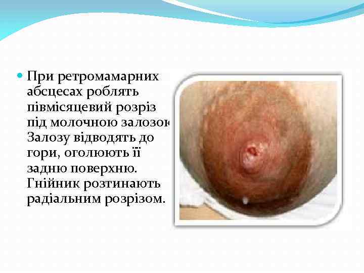  При ретромамарних абсцесах роблять півмісяцевий розріз під молочною залозою. Залозу відводять до гори,