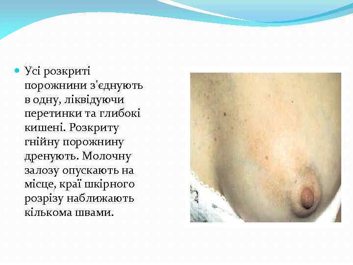  Усі розкриті порожнини з'єднують в одну, ліквідуючи перетинки та глибокі кишені. Розкриту гнійну