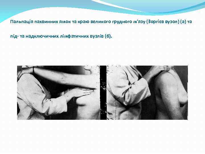 Пальпація пахвинних ямок та краю великого грудного м'язу (Зоргієв вузол) (а) та під- та