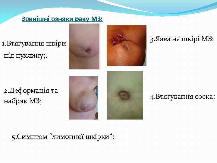 Зовнішні ознаки раку МЗ: 1. Втягування шкіри 3. Язва на шкірі МЗ; під пухлину;