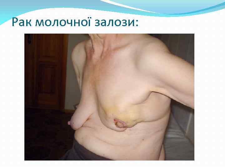 Рак молочної залози: 