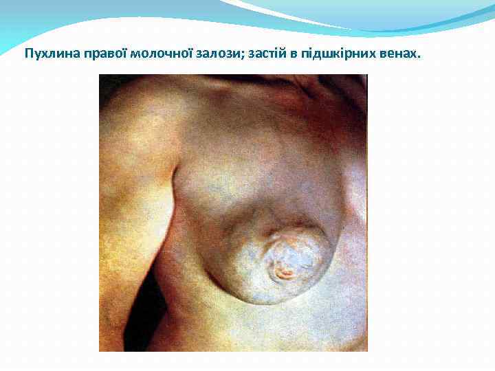 Пухлина правої молочної залози; застій в підшкірних венах. 