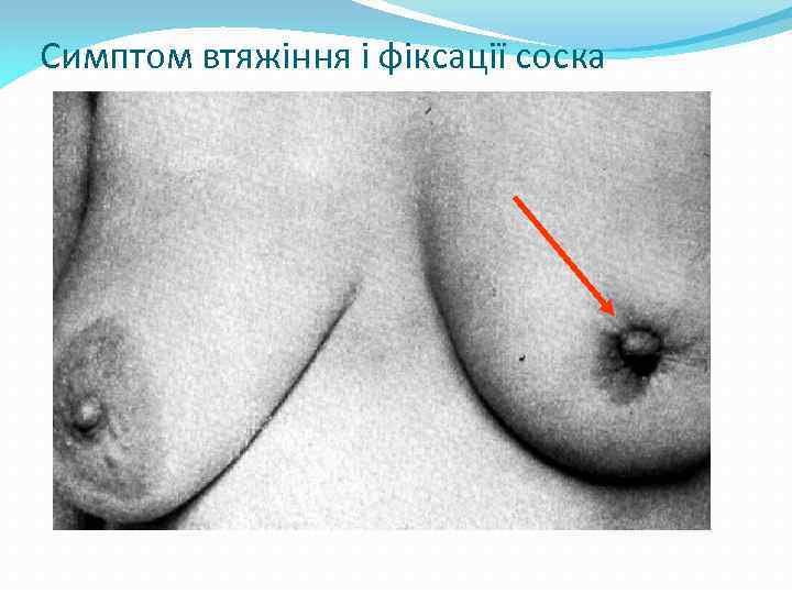 Симптом втяжіння і фіксації соска 