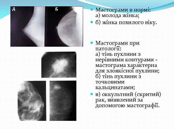  Мастограми в нормі: а) молода жінка; б) жінка похилого віку. Мастограми при патології: