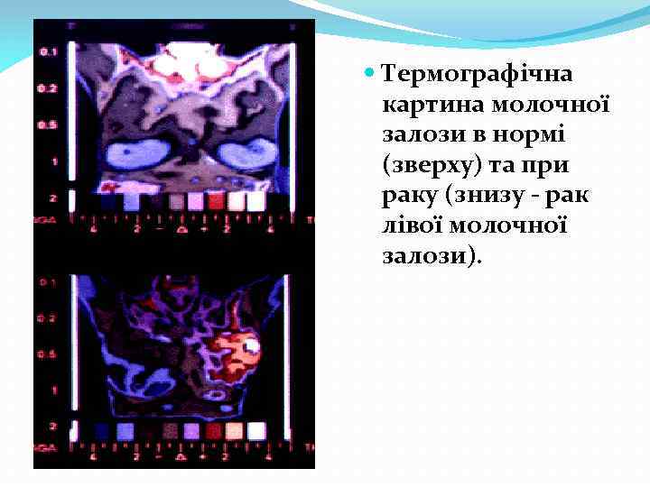  Термографічна картина молочної залози в нормі (зверху) та при раку (знизу - рак
