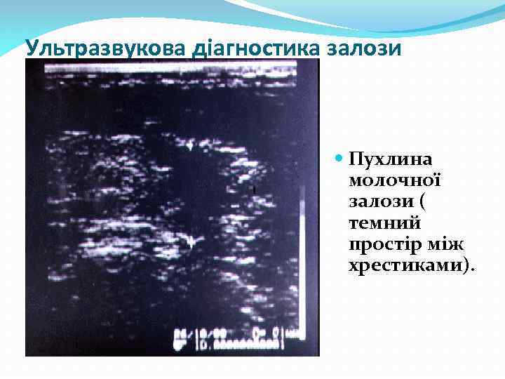 Ультразвукова діагностика залози Пухлина молочної залози ( темний простір між хрестиками). 