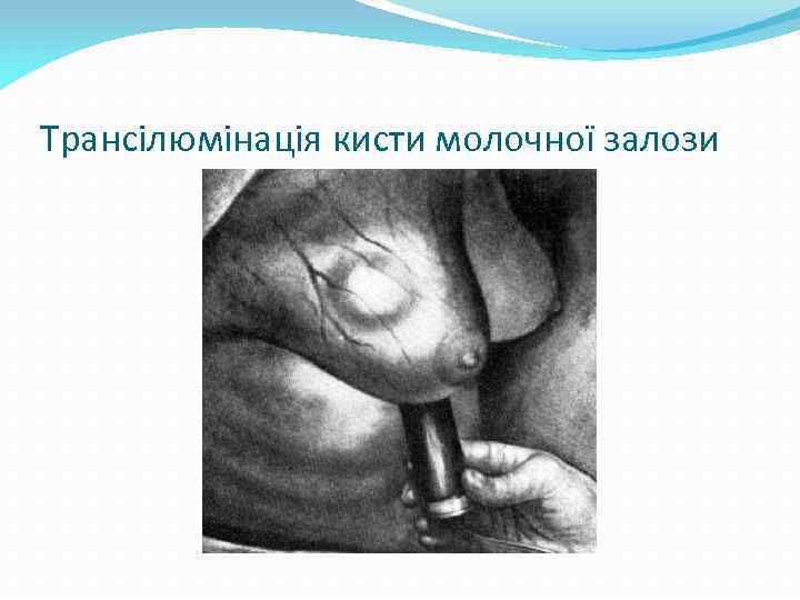 Трансілюмінація кисти молочної залози 