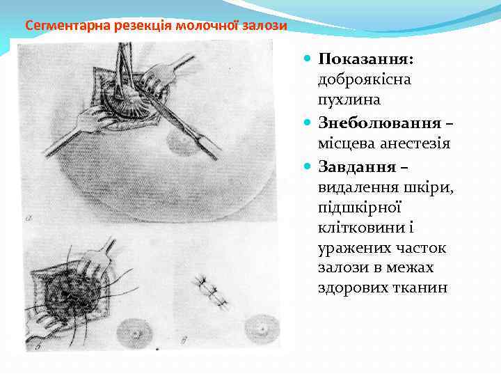 Сегментарна резекція молочної залози Показання: доброякісна пухлина Знеболювання – місцева анестезія Завдання – видалення