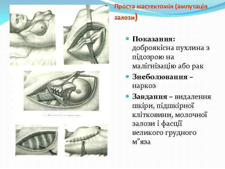 Проста мастектомія (ампутація залози) Показання: доброякісна пухлина з підозрою на малігнізацію або рак Знеболювання