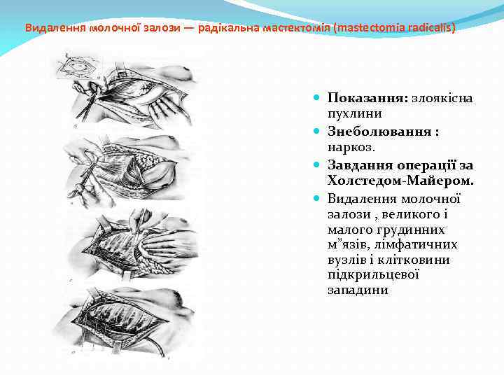 Видалення молочної залози — радікальна мастектомія (mastectomia radicalis) Показання: злоякісна пухлини Знеболювання : наркоз.