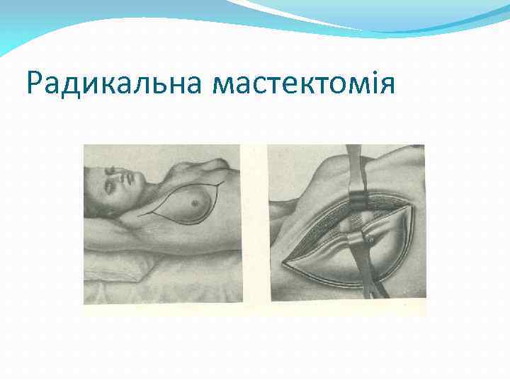 Радикальна мастектомія 