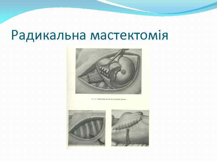 Радикальна мастектомія 