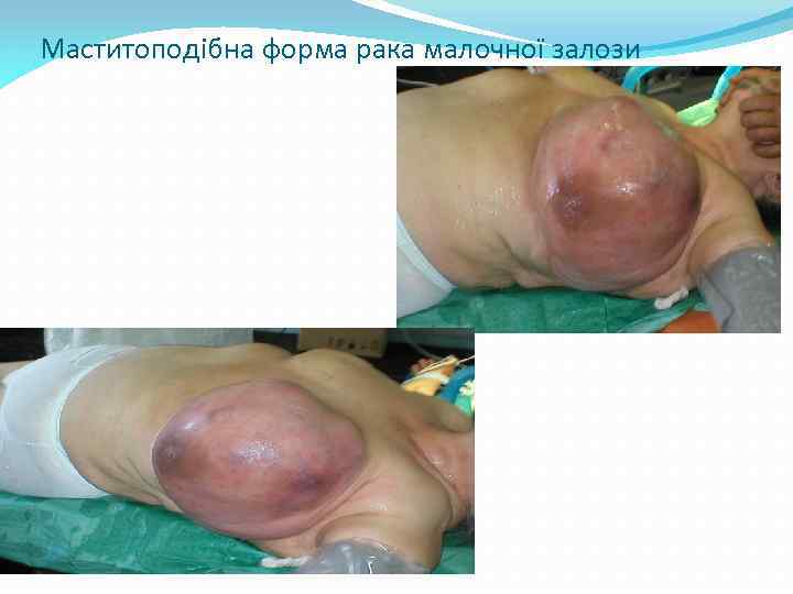 Маститоподібна форма рака малочної залози 