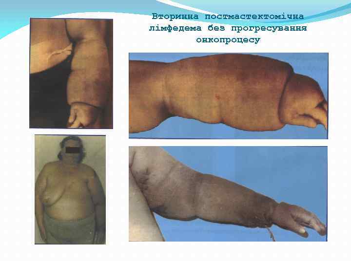 Вторинна постмастектомічна лімфедема без прогресування онкопроцесу 