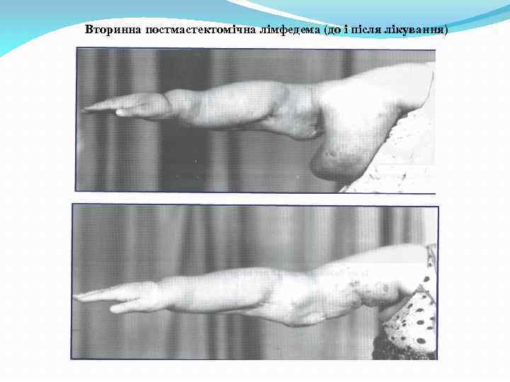 Вторинна постмастектомічна лімфедема (до і після лікування) 