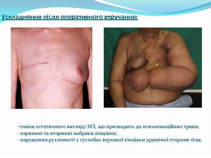 Ускладнення після оперативного втручання: зміни естетичного вигляду МЗ, що призводить до психоемоційних травм; -