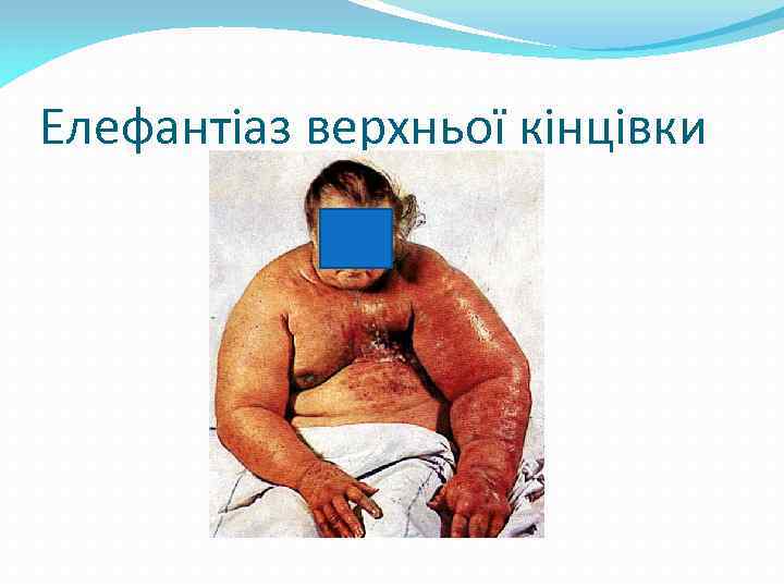 Елефантіаз верхньої кінцівки 