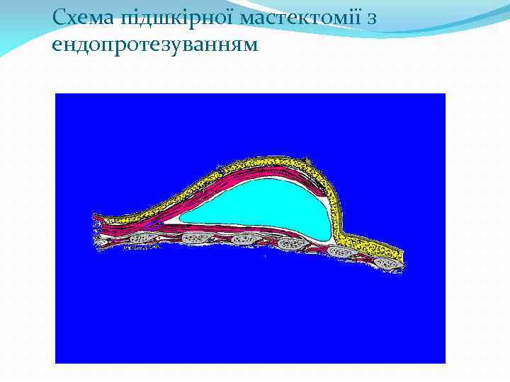 Схема підшкірної мастектомії з ендопротезуванням 