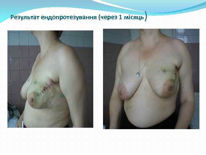 Результат ендопротезування (через 1 місяць ) 
