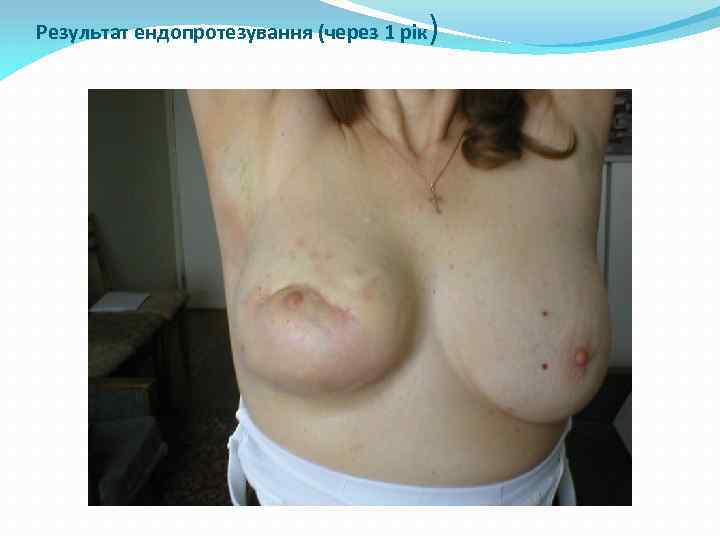 Результат ендопротезування (через 1 рік ) 