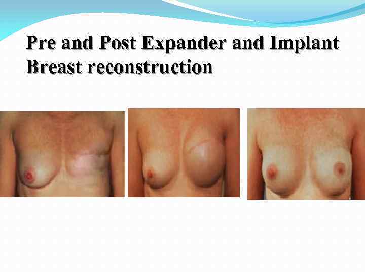 Pre and Post Expander and Implant Breast reconstruction 