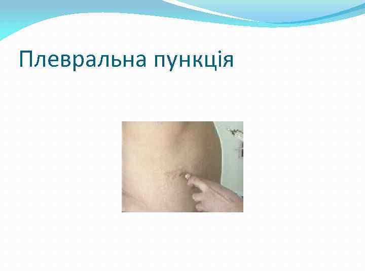 Плевральна пункція 