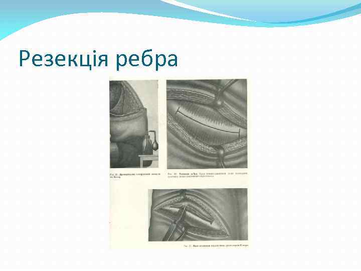 Резекція ребра 