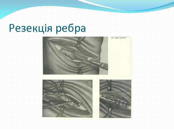 Резекція ребра 