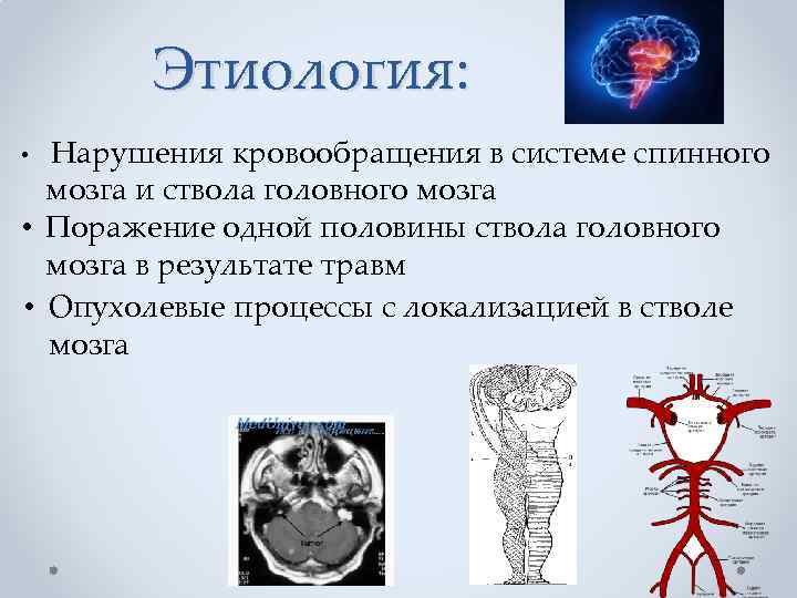 Этиология: • Нарушения кровообращения в системе спинного мозга и ствола головного мозга • Поражение