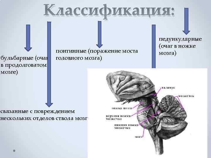 Классификация: понтинные (поражение моста бульбарные (очаг головного мозга) в продолговатом мозге) связанные с повреждением