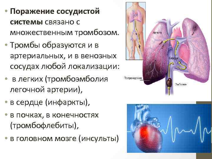  • Поражение сосудистой системы связано с множественным тромбозом. • Тромбы образуются и в