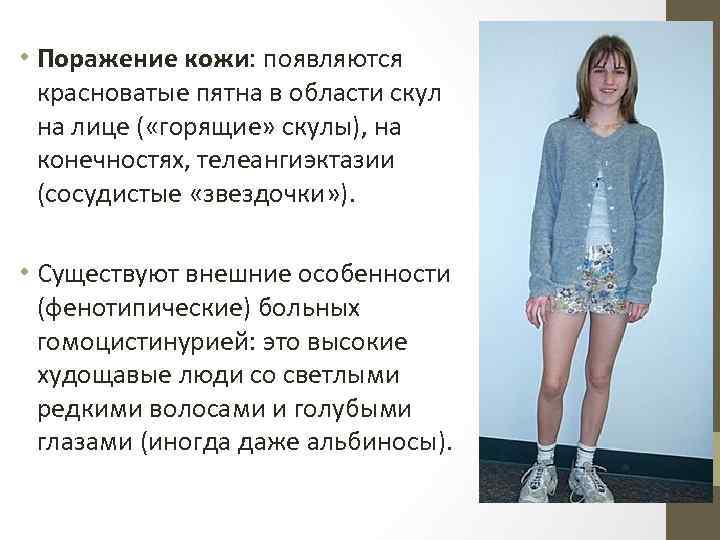  • Поражение кожи: появляются красноватые пятна в области скул на лице ( «горящие»