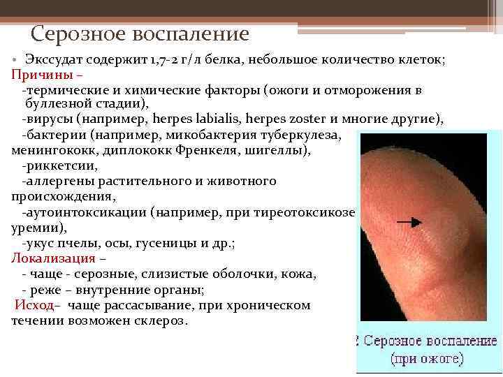 Серозное воспаление • Экссудат содержит 1, 7 -2 г/л белка, небольшое количество клеток; Причины