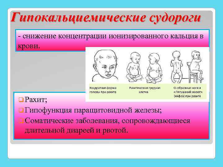 Гипокальциемические судороги - снижение концентрации ионизированного кальция в крови. q Рахит; q Гипофункция паращитовидной