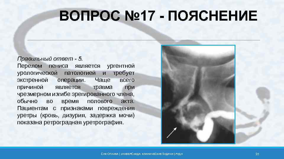 ВОПРОС № 17 - ПОЯСНЕНИЕ Правильный ответ - 5. Перелом пениса является ургентной урологической