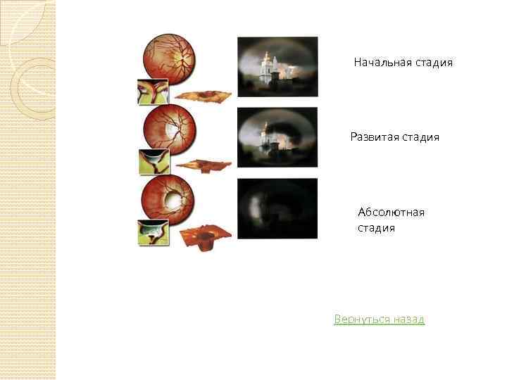 Начальная стадия Развитая стадия Абсолютная стадия Вернуться назад 