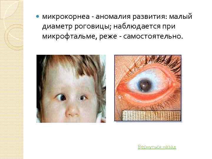  микрокорнеа аномалия развития: малый диаметр роговицы; наблюдается при микрофтальме, реже самостоятельно. Вернуться назад