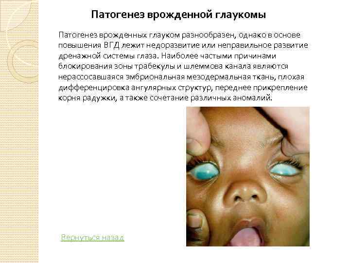 Патогенез врожденной глаукомы Патогенез врожденных глауком разнообразен, однако в основе повышения ВГД лежит недоразвитие