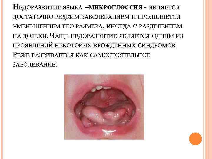 НЕДОРАЗВИТИЕ ЯЗЫКА – ИКРОГЛОССИЯ - ЯВЛЯЕТСЯ М ДОСТАТОЧНО РЕДКИМ ЗАБОЛЕВАНИЕМ И ПРОЯВЛЯЕТСЯ УМЕНЬШЕНИЕМ ЕГО